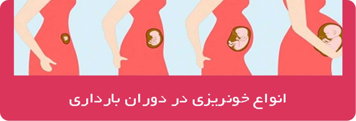 انواع خون ریزی در دوران بارداری